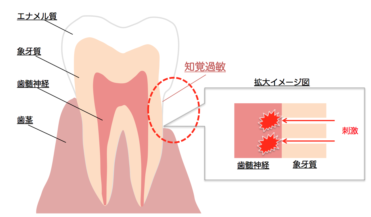 激痛 後 虫歯 治療