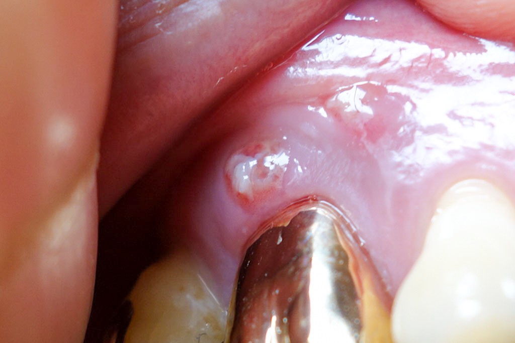 腫れ 膿 歯茎