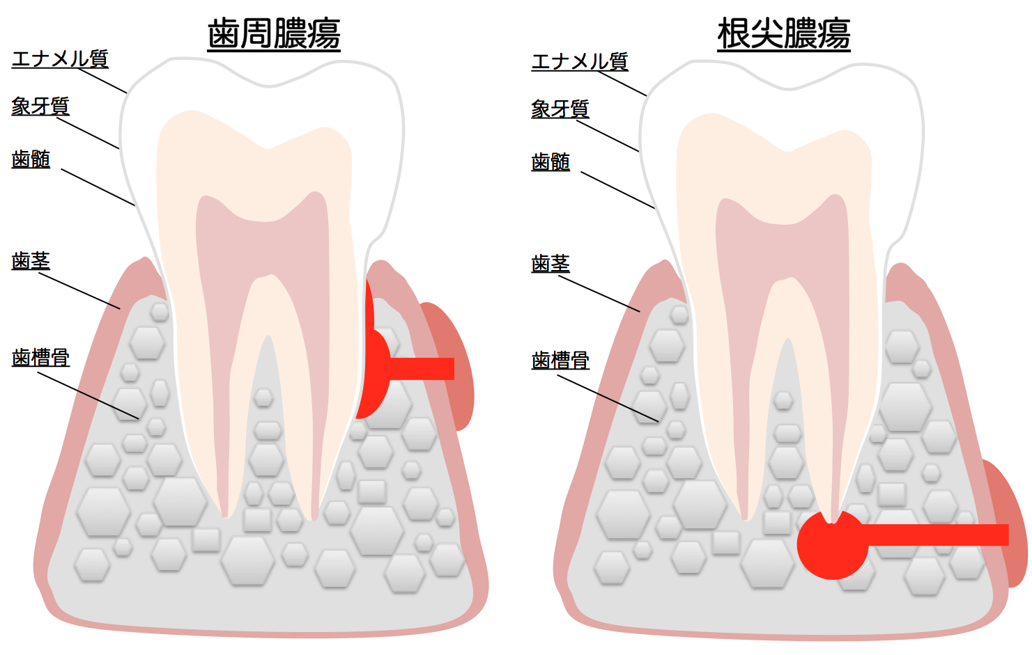 の 方 出し の 腫れ 膿 歯茎