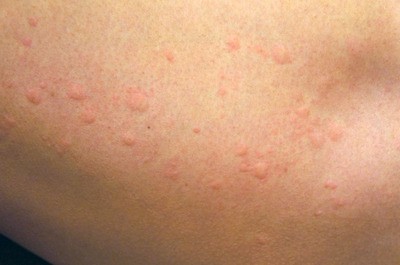 寒冷蕁麻疹は治りますか？